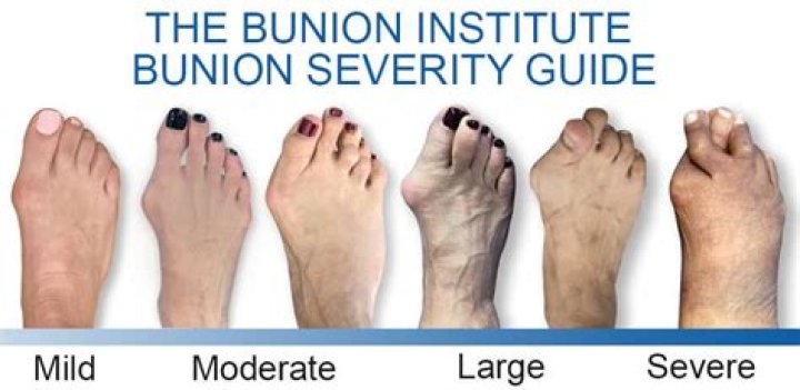 Do bunions go away?